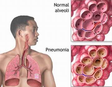 Tất tần tật thông tin về viêm phổi do S.pneumoniae, có thể bạn chưa biết
